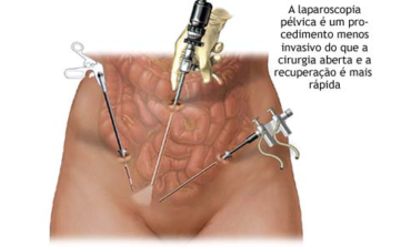 Operação de endometriose