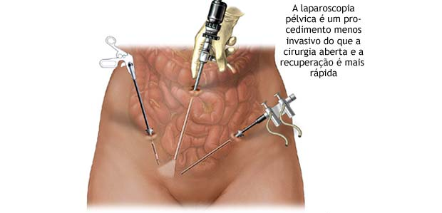 Como é o pós-operatório da cirurgia de câncer de ovário