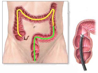 Preparando-se para uma cirurgia coloretal