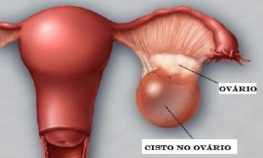 Cisto ovariano