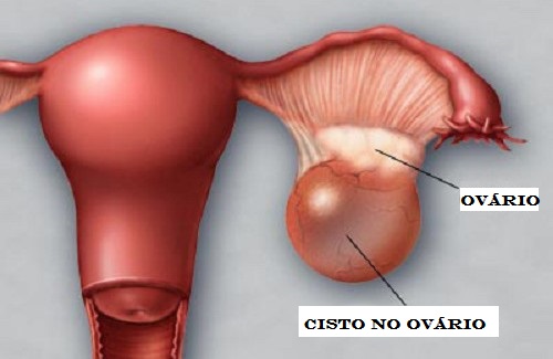 Apareceu um cisto no ovário? Veja o que fazer!